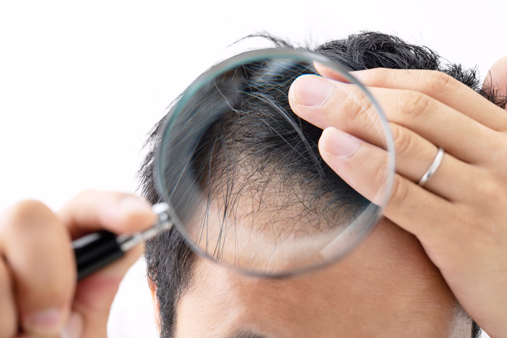 Tipos de alopecia que solucionamos en el centro capilar Mayquel