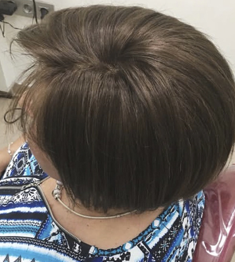 Cabello con volumen y densidad recuperados tras la prótesis capilar para mujer