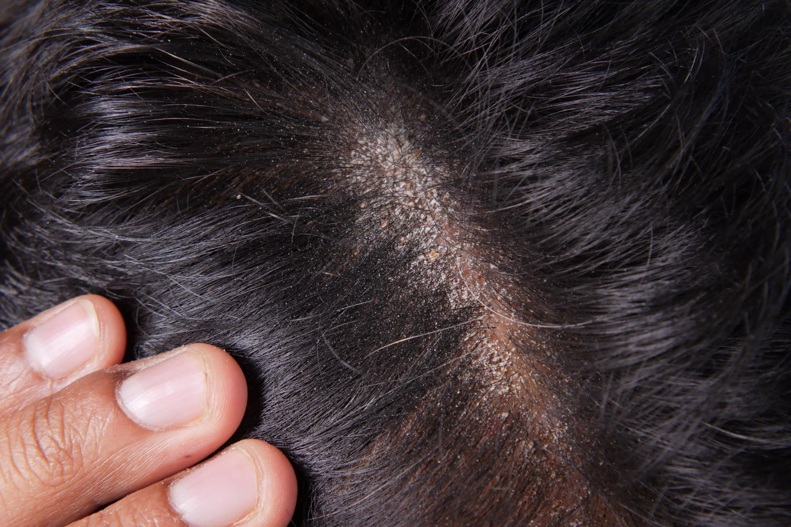 ¿La psoriasis puede provocar la caída del cabello?