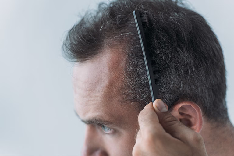 6 consejos para evitar la caída de pelo