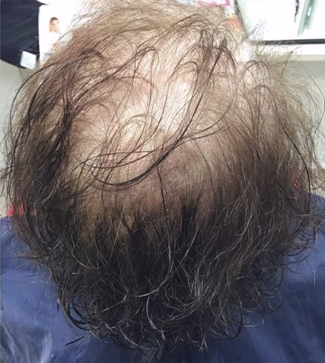 Mujer con pérdida de cabello antes de la peluca natural en Barcelona
