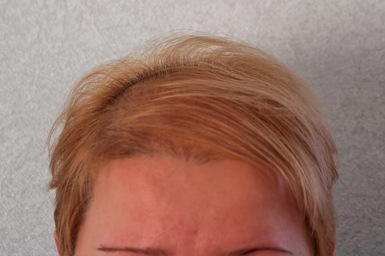 Caída del pelo en la menopausia