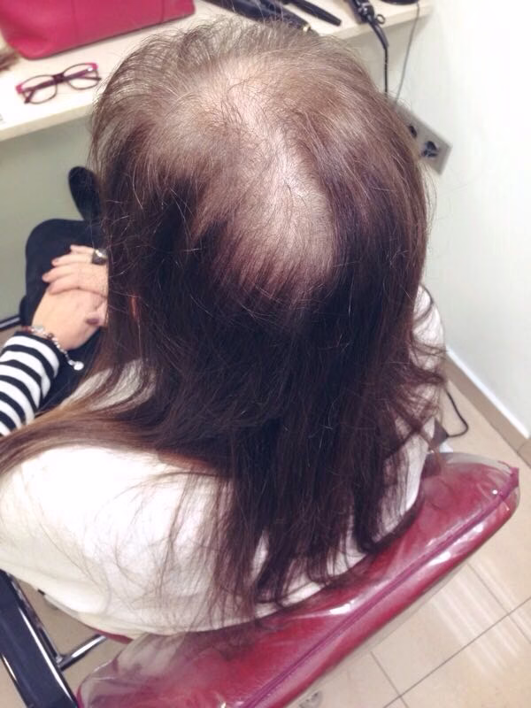 Extensiones para tapar calvas en la cabeza