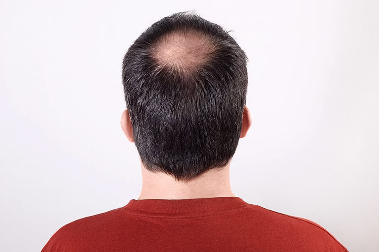 ¿Qué tipos de alopecia existen?