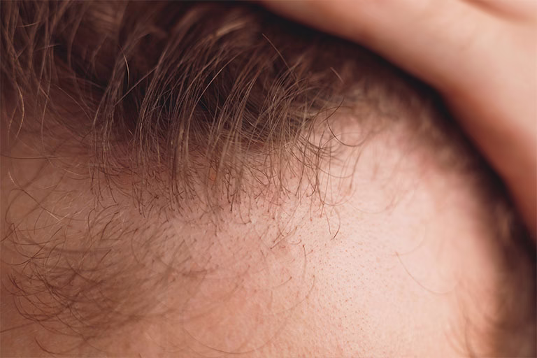 Alopecia frontal fibrosante: ¿Cómo saber si la padezco?