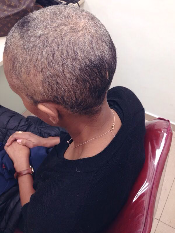 Mujer con pérdida de cabello antes de la peluca natural en Barcelona